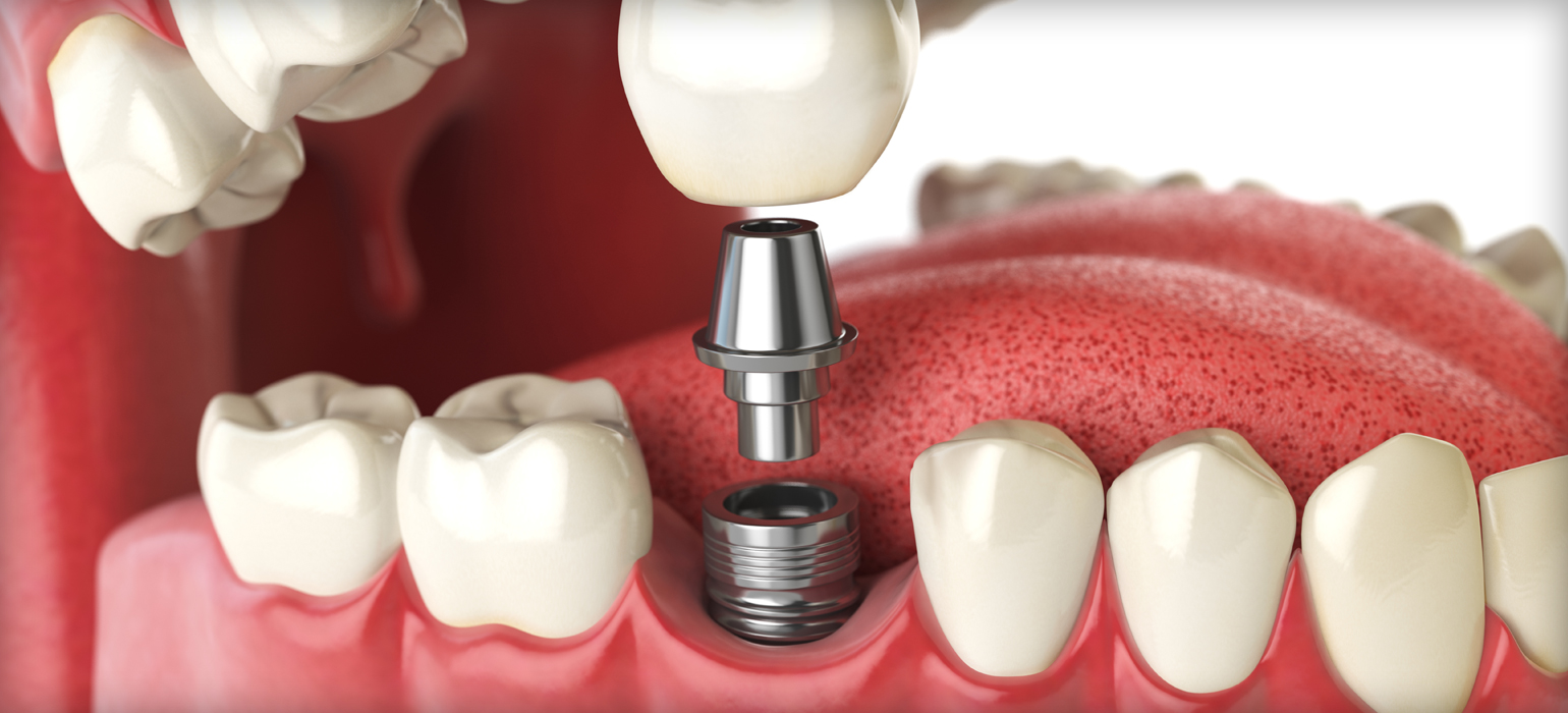 rendering of tooth implant